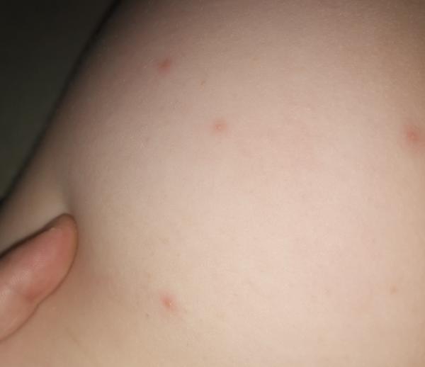 Čo to má 4-ročná dcéra za vyrážky?