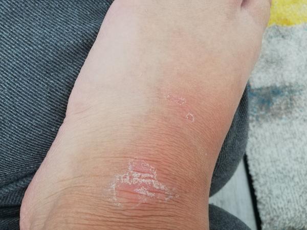 Kožné problémy - čo to môže byť?