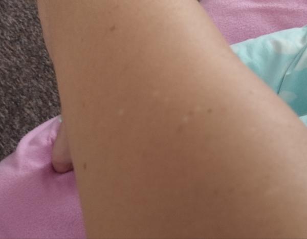 Čo sú biele bodky na rukách a pleciach?