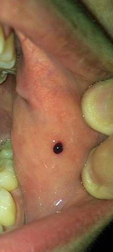 Červená bodka v ústach dvojročného