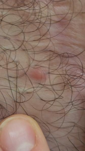 Kliešť - návšteva lekára