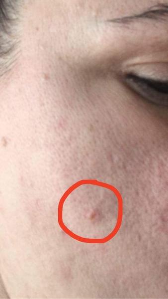 Aký kožný útvar mám na líci?