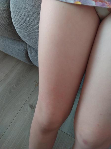 Príznaky ovčích kiahní u detí