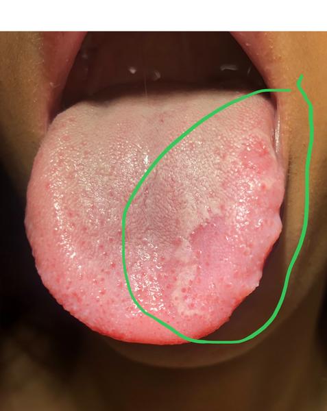 Čo znamenajú opakujúce sa fľaky na jazyku?