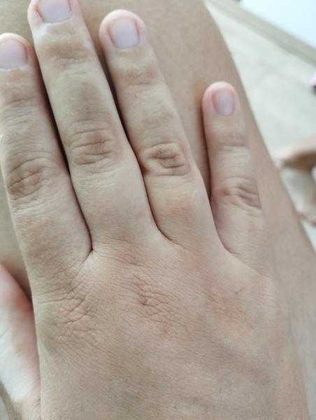 Čo spôsobuje hnedé škvrny na rukách?