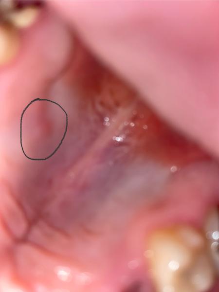 Hrčka na podnebí: Čo s ňou robiť?