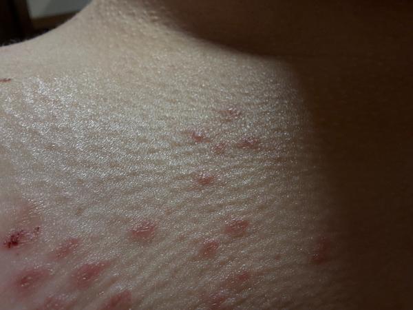 Ako riešiť vyrážky v tehotenstve bez kortikoidov?