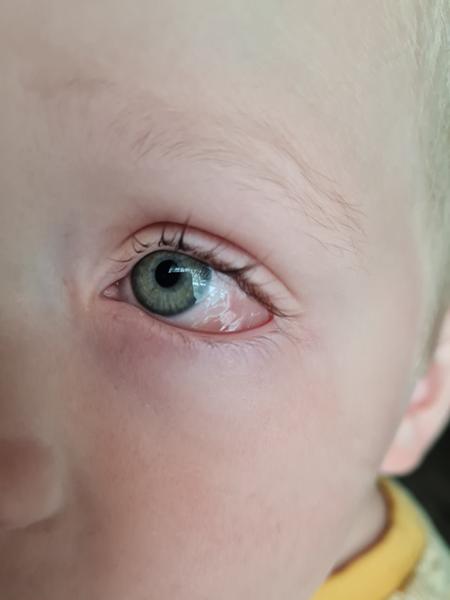 Je opuch očného bielka u trojročného syna v poriadku?