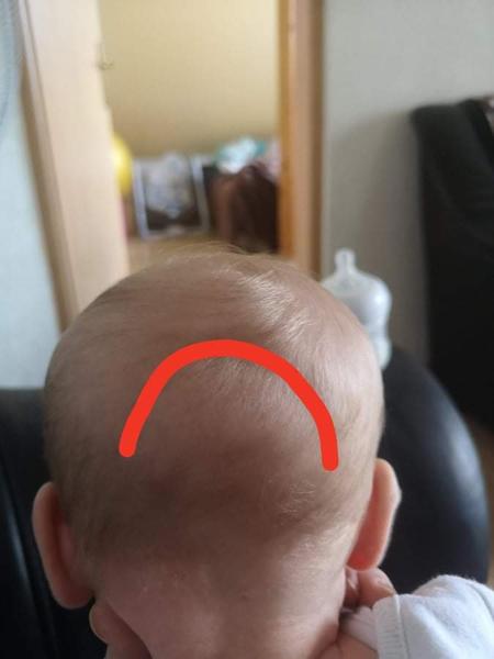 Mesačná dcérka má vzadu na hlavičke priehlbinku