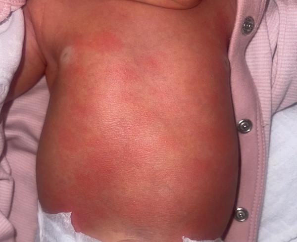 Čo spôsobuje červené fľaky u novorodenca?