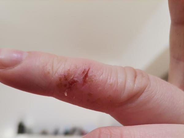 Zapálené pľuzgiere na prstoch