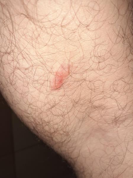 O aký kožný problém ide?