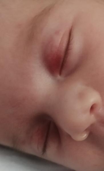 Čo znamenajú červené fľaky na očiach novorodeneca?