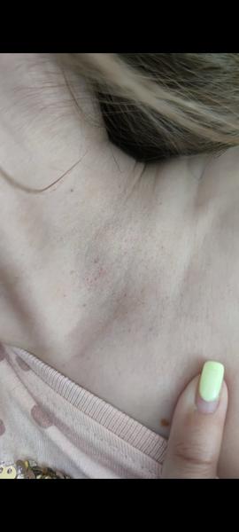 Poscovidová syndróm