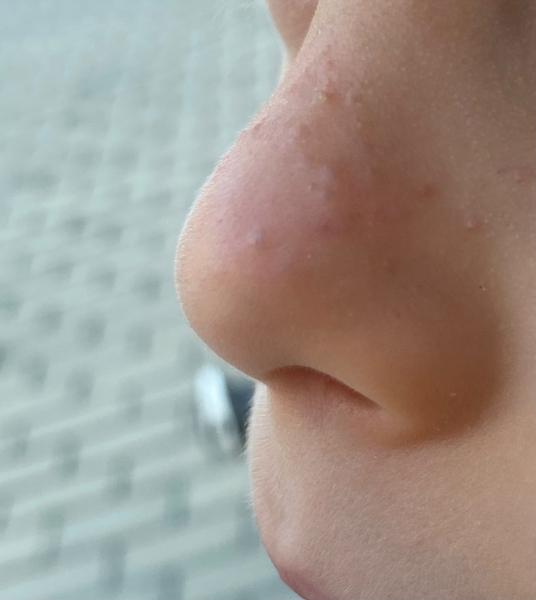 Ako riešiť letné vyrážky na nose u detí?