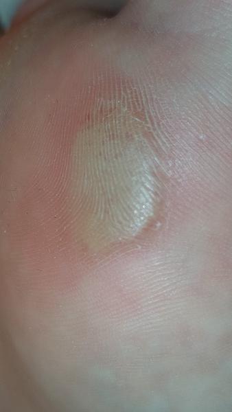 Je to otlak alebo bradavica?