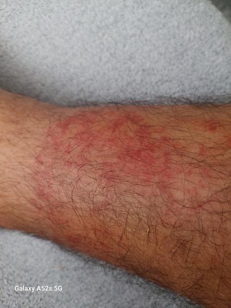 Čo môže byť tá hrčka na nohe?