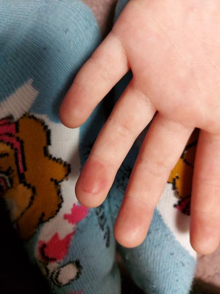 Aký fľak má moja 5-ročná dcéra?