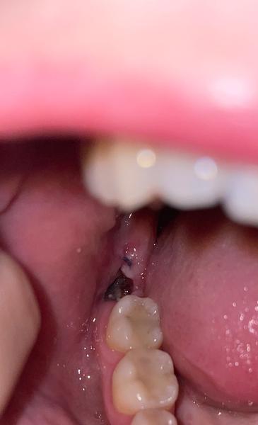 Bolesť po trhaní osmičky