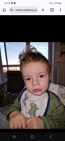 Nejasný červený fliačik na tvári dieťaťa: Máte skúsenosti?