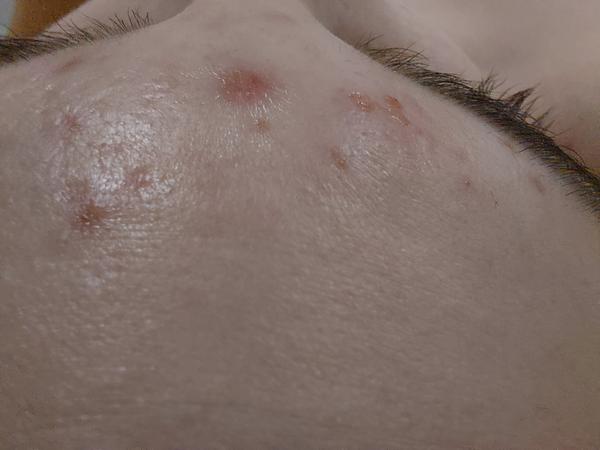 Chrastičky a citlivá pleť u 14-ročnej