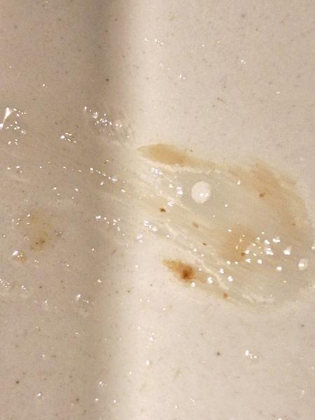 Čo znamenajú červeno-hnedé čiastočky v slinách?