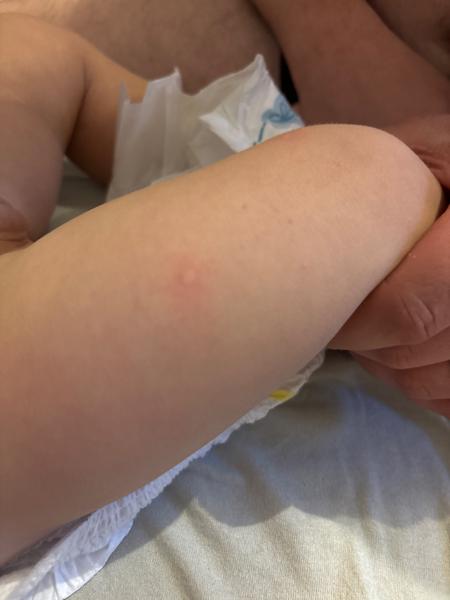 Príčiny vyrážok u ročného dieťaťa