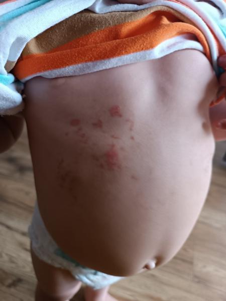 Chrasty na brušku: Je to reakcia na hmyz?