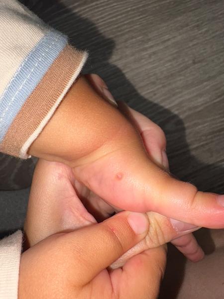 Vyrážka na ruke dieťaťa