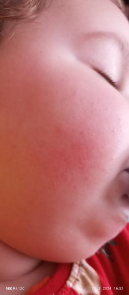 Čo spôsobuje vyrážky na lícach a tele?