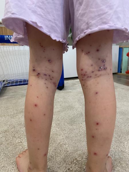 Výzor pokožky po kiahňach a starostlivosť