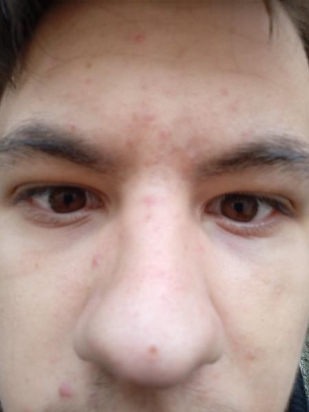 Ako riešiť problém s akné u šestnásťročného chlapca?