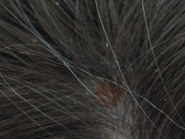 Fľak na hlave: Mliečna chrasta alebo niečo iné?