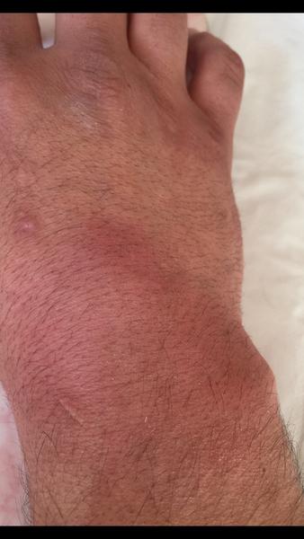 Prečo ma po operácii karpálneho tunela stále bolí zápästie?