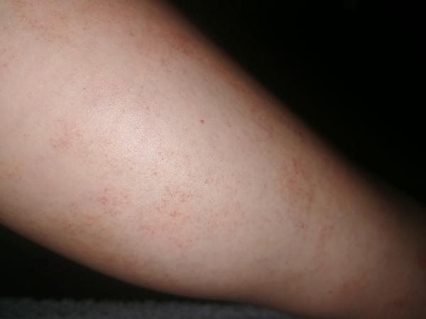 Prečo mi od kolena nižšie vznikajú malé červené bodky?