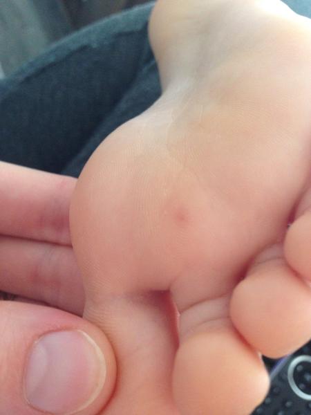 Bolesť chodidla po poštípaní včelou. Čo nám odporúčate?