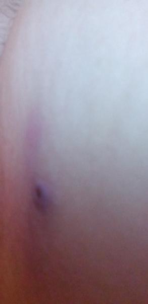 Znamienko a šúchanie stehien