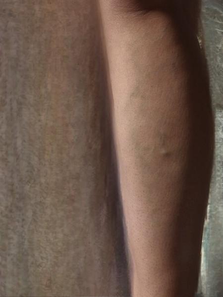 Je bolesť pri kŕčových žilách normálna?