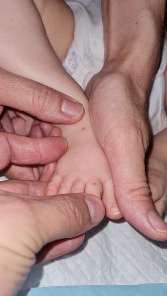 Vyrážka u 8-mesačného