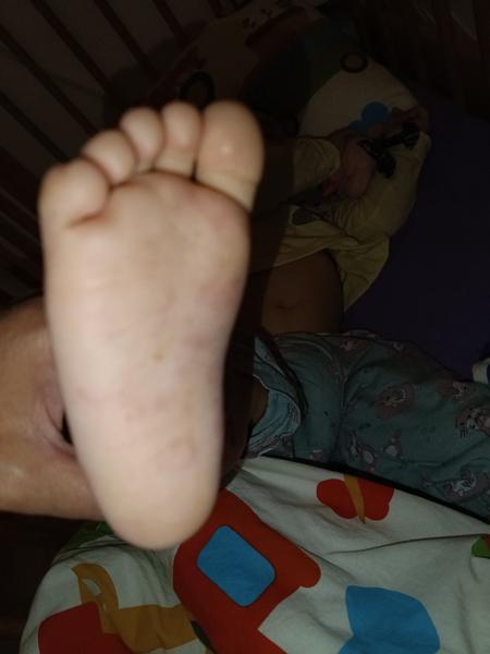 Opakujúci sa problém s vyrážkami na chodidlách dieťaťa