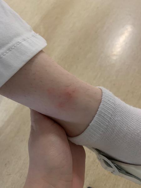 Je toto štípanec od ploštíc?