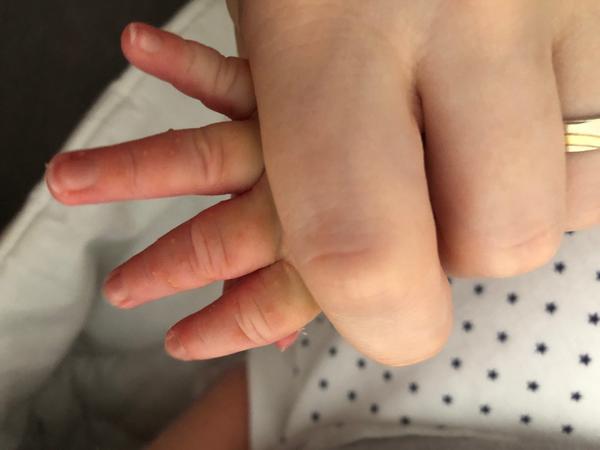 Čo sú to za vyrážky u 2-týždňového bábätka?