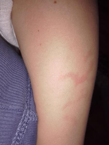 Červené fľaky po rukách - skúsenosti