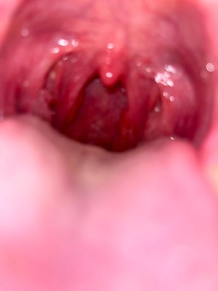 Je zapálené hrdlo príčinou vašich problémov?