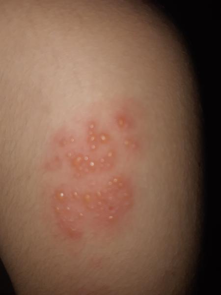 Aký problém znamená zhluk vyrážok u 7-ročného syna?