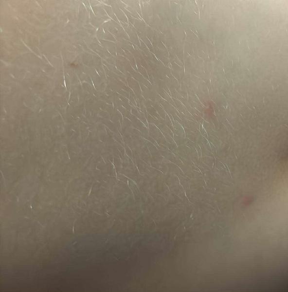 Ako rozpoznať kiahne a čo pomôže rýchlejšiemu vývoju?