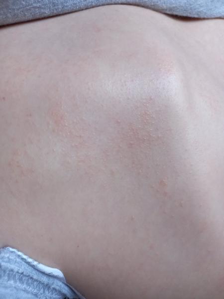 Je toto atypický ekzém?