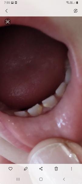 Môže mať trojročný syn sfarbené zúbky kvôli antibiotikám?