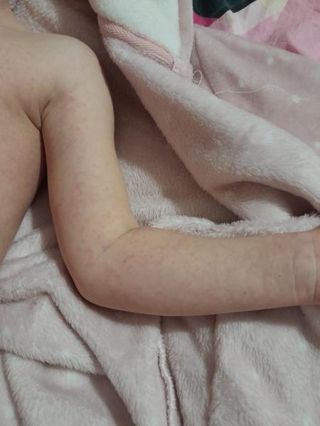 Bodky po tele 3-ročnej