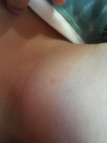 Sú vyrážky u detí ako kiahne? Skúsenosti rodičov